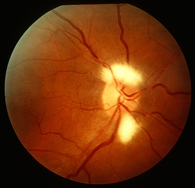 Myelinated nerve fiber layer retina image bank
